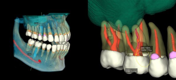 Example of using AI to estimate clinically relevant anatomical clinical structures(left), AI 3D Segmentation tech(right)