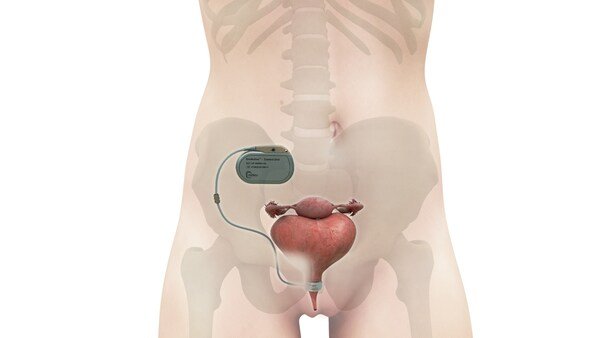 UroMems announced  that it has successfully completed the first-ever implant of the UroActive™ smart, automated artificial urinary sphincter (AUS) in a female patient to treat stress urinary incontinence (SUI). This milestone indicates a new era for milli